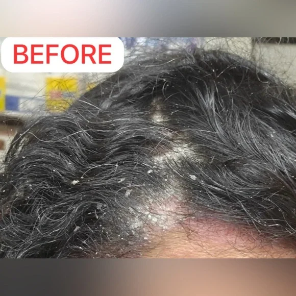 Nizoral Anti-Dandruff Shampoo - Picture 2 of 4